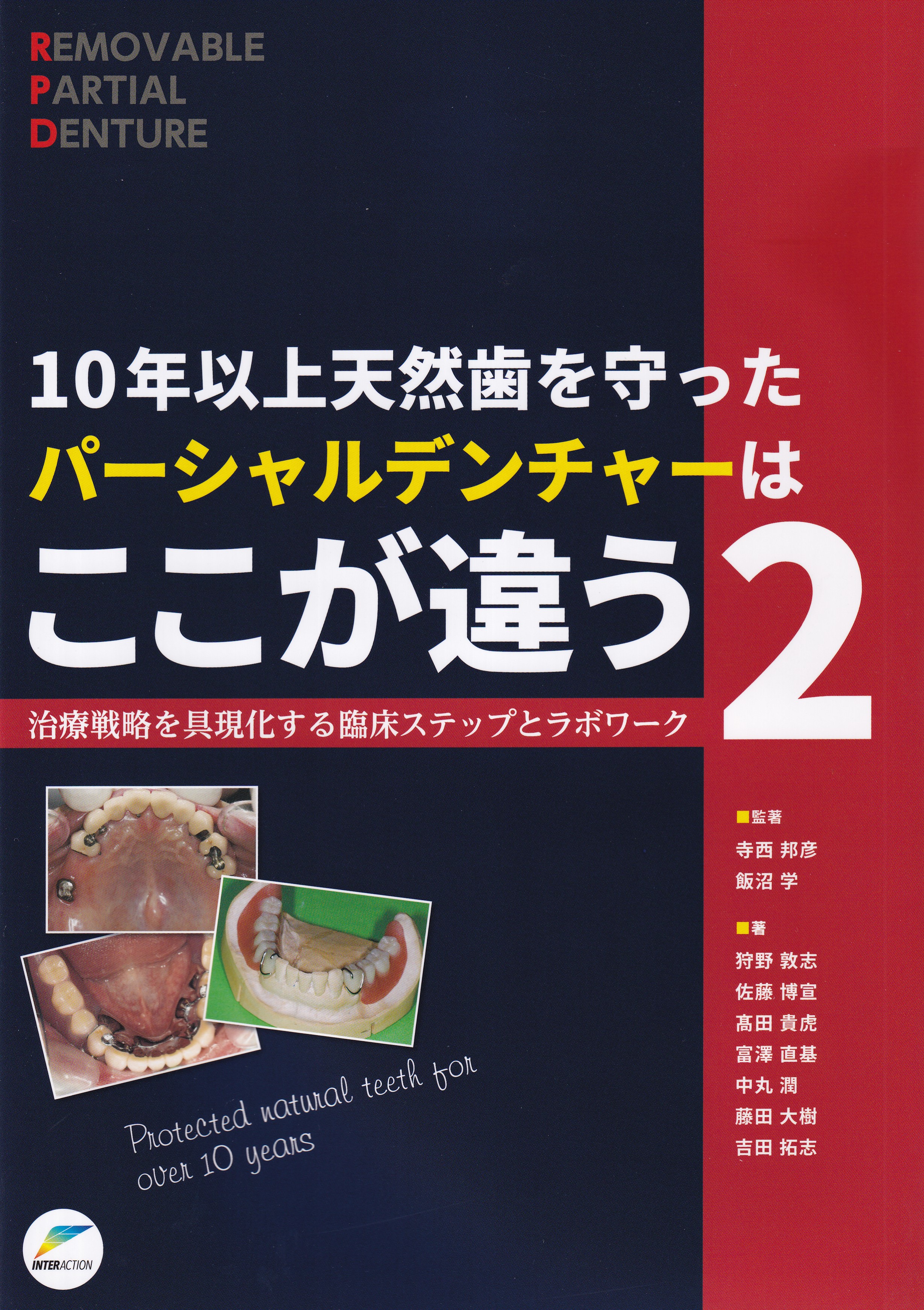 10年以上天然歯を守ったパーシャルデンチャーはここが違う 2